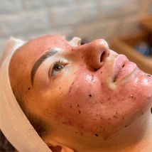 A woman with acne on her face and neck.